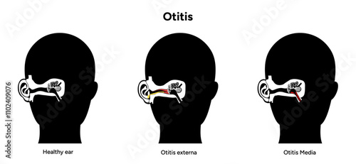Otitis media and externa human ear anatomy disease medical infographic 