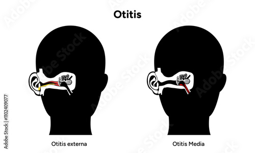 Otitis media and externa human ear anatomy disease medical infographic 