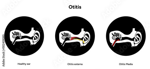 Otitis media and externa human ear anatomy disease medical infographic 