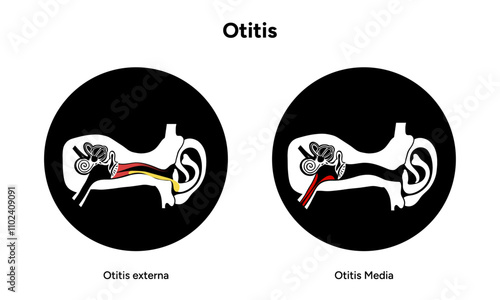 Otitis media and externa human ear anatomy disease medical infographic 