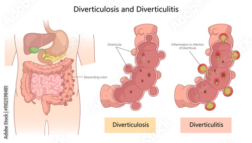 diverticulosis and diverticulitis, showing diverticula formation in the colon and inflamed or infected areas diagram hand drawn schematic vector illustration. Medical science educational illustration