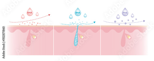 Comparison of Alpha, Beta, Poly Hydroxy Acids characteristics illustration. AHA exfoliate the surface skin. BHA penetrate deep into the pore. PHA dissolve the surface, large molecule, penetrate less.