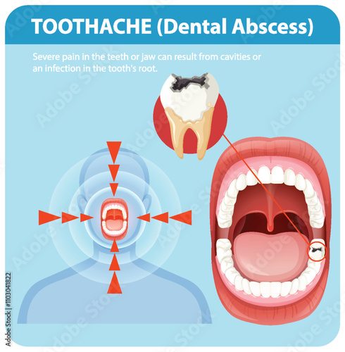 Understanding Toothache and Dental Abscess