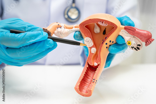 Uterus, doctor holding human anatomy model for study diagnosis and treatment in hospital. photo