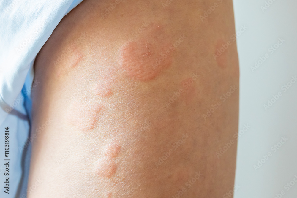Young asian man has allergic skin rash on his legs from itchy dry skin eczema dermatitis insect bites Young asian man has allergic skin rash on his legs from itchy dry skin eczema dermatitis insect bites