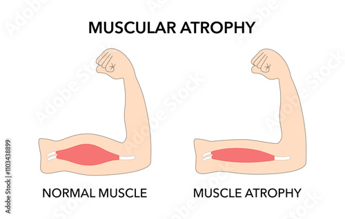 Muscular atrophy compared to healthy outline diagram. Weakness abnormal muscle and normal movement disability vector illustration.