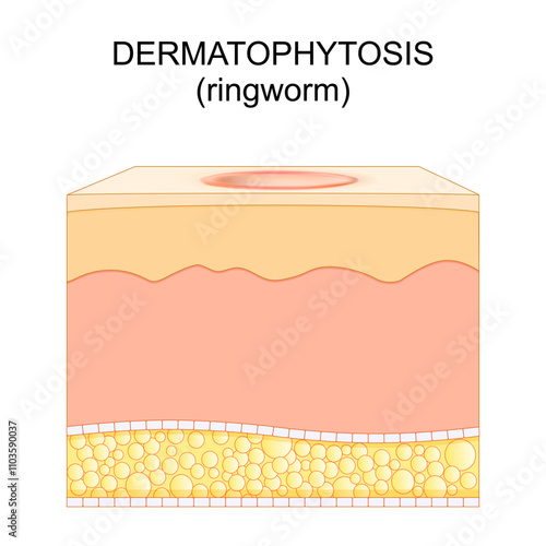 Dermatophytosis. human skin with Ringworm.