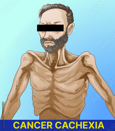 Cachexia. Cancer Cachexia. A human body with serious health problems. Educational illustration. Healthcare illustration. Vector illustration. 