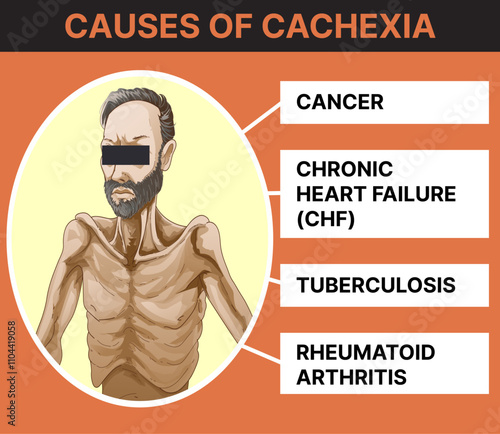 Causes of cachexia. Infographics. healthcare illustration. Vector illustration. 