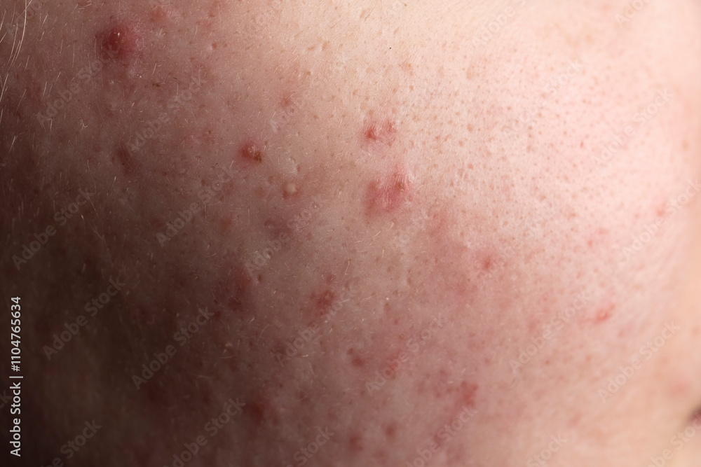 Fototapeta premium Dermatological acne. Skin texture background. Closeup acne pimple. Problem skincare. Pimples, acne, pores, scars. Natural skin. Skin care concept. Acne treatment. Pimples on skin.