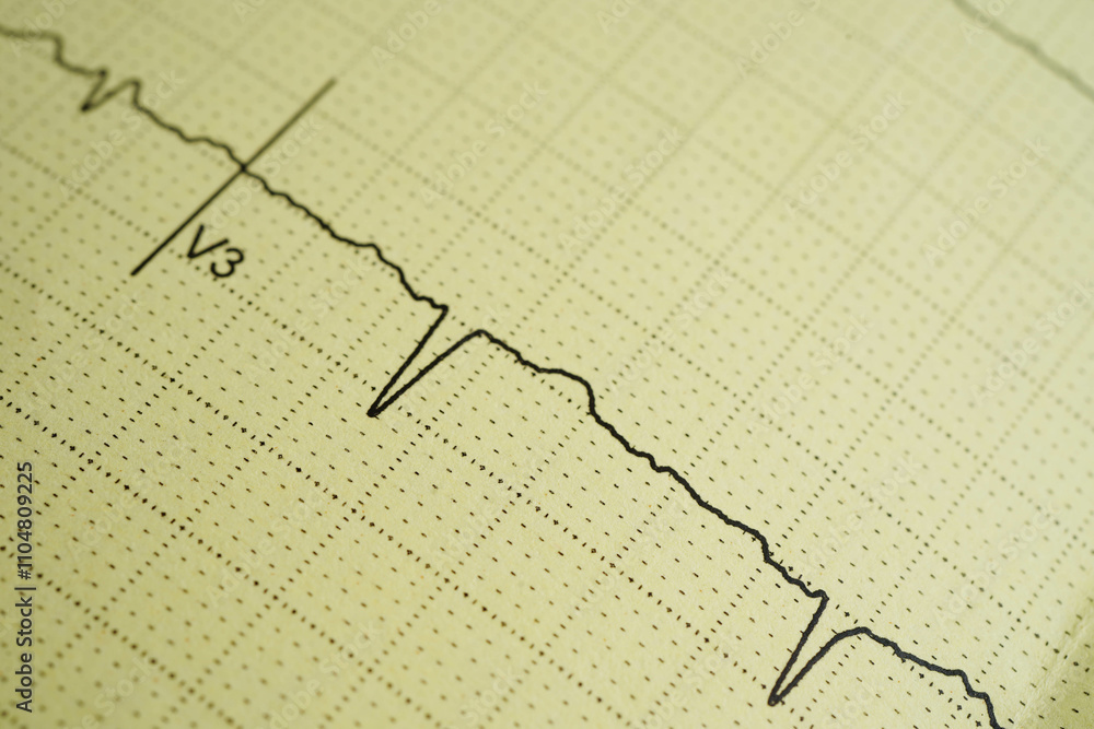 Electrocardiogram (ECG), heart wave, heart attack, cardiogram report. Electrocardiogram (ECG), heart wave, heart attack, cardiogram report.