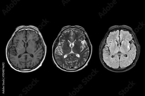 MRI  brain scan  axial T1W ,T2W and Flair for detect  Brain  diseases sush as stroke disease, Brain tumors and Infections.