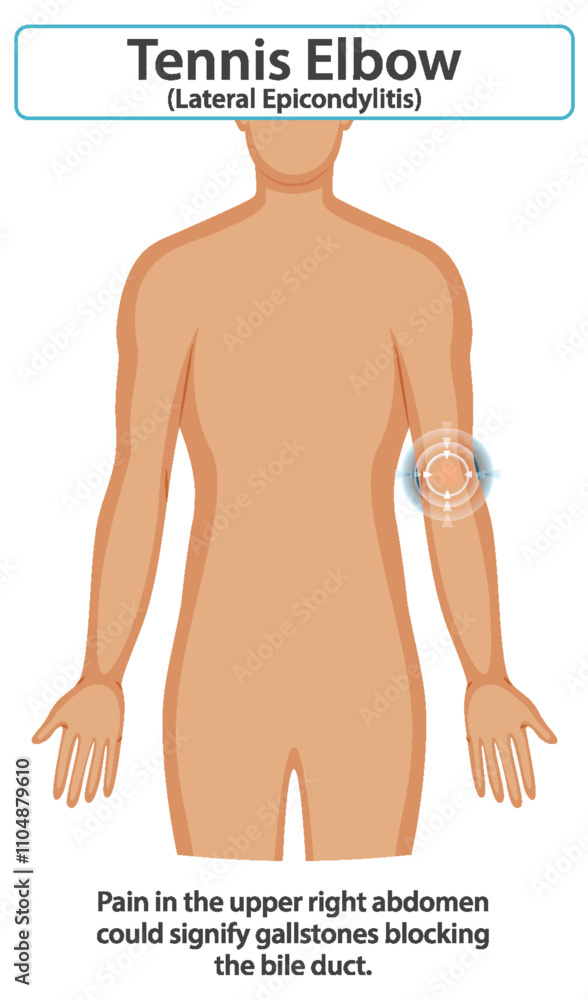 Fototapeta premium Tennis Elbow Medical Illustration