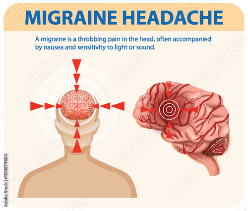 Understanding Migraine Headache Symptoms