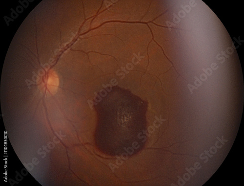 Retinal Fundus Image with Pigmented Lesion photo