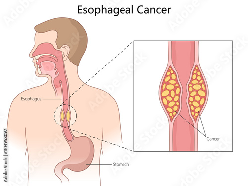 esophageal cancer, highlighting the affected esophagus area with a close-up of tumor cells diagram hand drawn schematic vector illustration. Medical science educational illustration