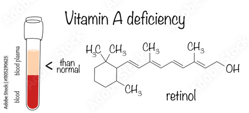Vitamin A deficiency