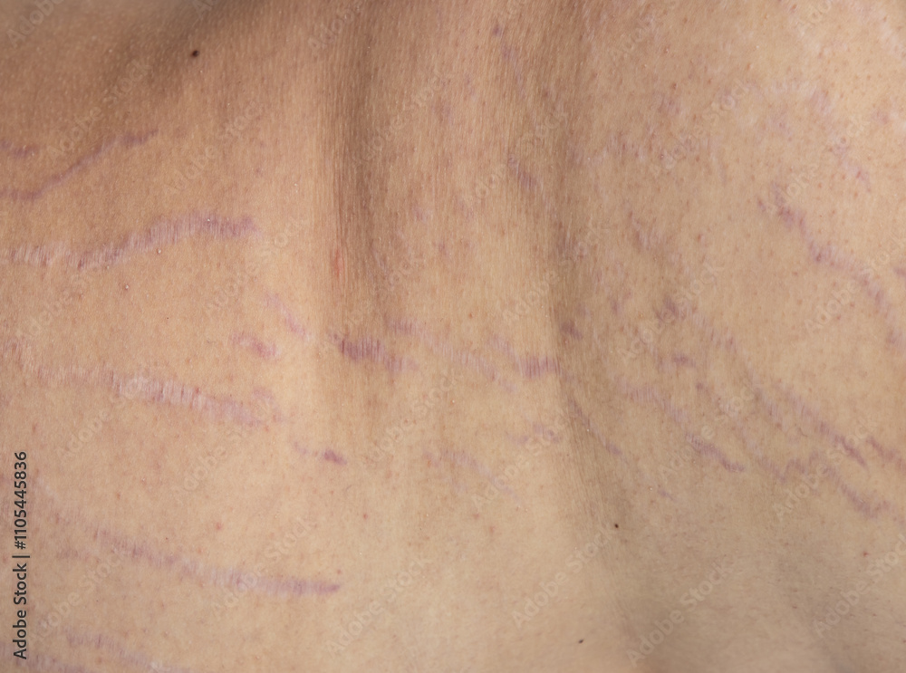 Fototapeta premium A person's back with a scar on it
