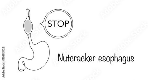 Nutcracker esophagus