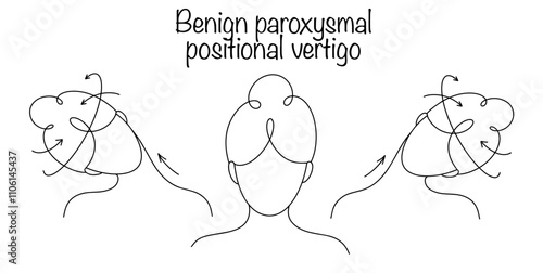 Benign paroxysmal positional vertigo