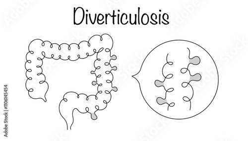 Diverticulosis