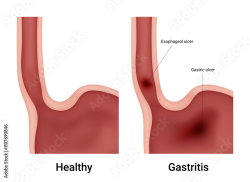Difference between normal human stomach and gastritis
