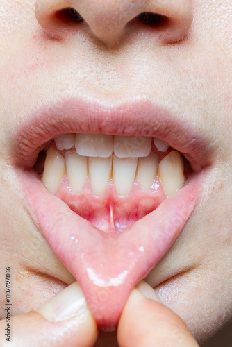 Woman showing her short frenulum of lower lip, close-up view