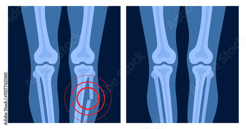 XRayBonesFractures-03.eps