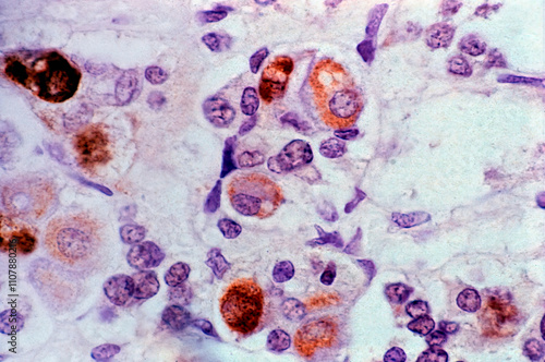 Pituitary gland. Crooke change. Ubiquitin photo