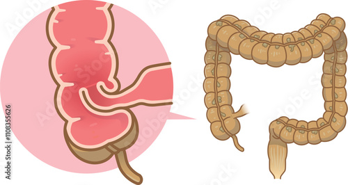 腸重積症、Intussusception、イラスト