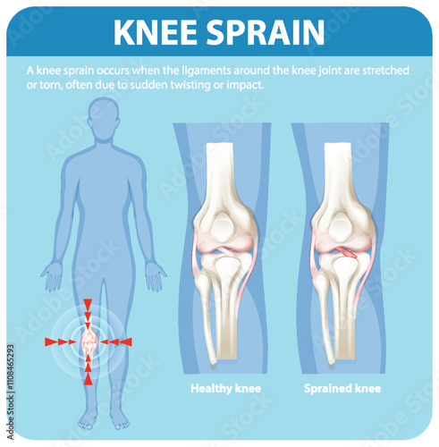 Understanding Knee Sprain and Its Effects