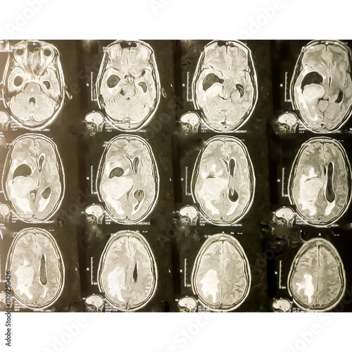 MRI scan of brain, Intraventricular hemangioma with adjoining periventricular seepages and herniation. photo