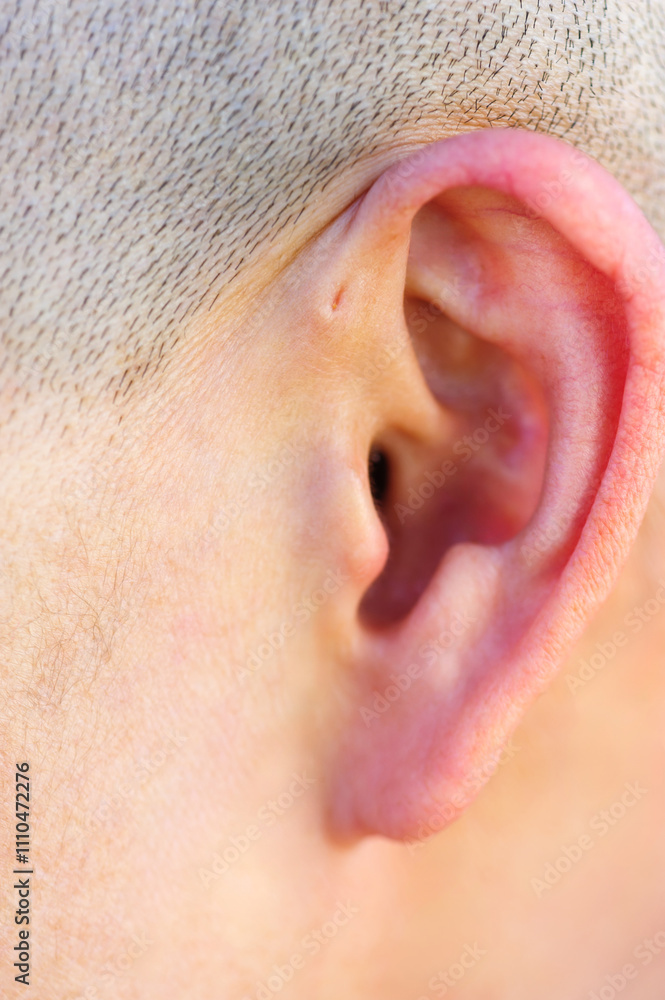 A preauricular sinus appears as a very small pit just in front of the external ear, these sinuses can drain a foul smelling discharge, and when this happens, they are prone to chronic infection. A preauricular sinus appears as a very small pit just in front of the external ear, these sinuses can drain a foul smelling discharge, and when this happens, they are prone to chronic infection.