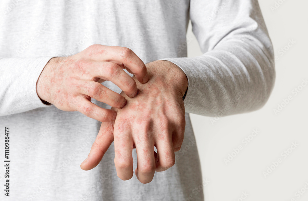 Red spots on hands. Man itches, free space Red spots on hands. Man itches, free space