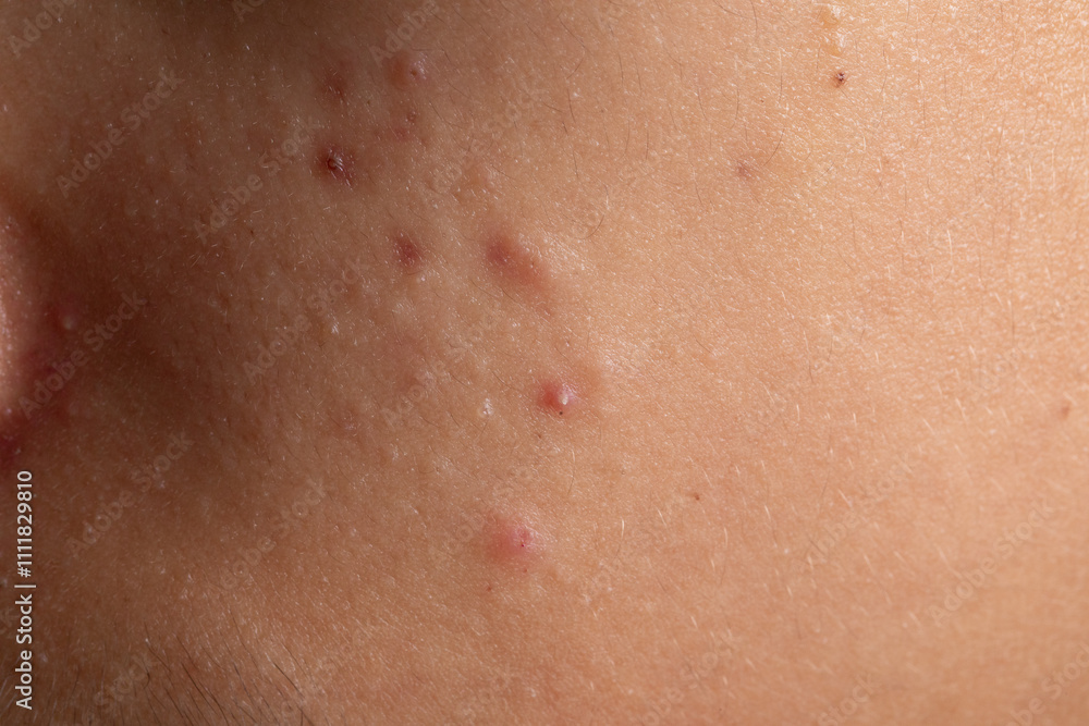 Fototapeta premium Acne problem, close-up of inflamed pimples on skin