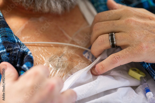 Cancer patient in hospital with portacath medical device in chest - Port-a-cath (Port) photo