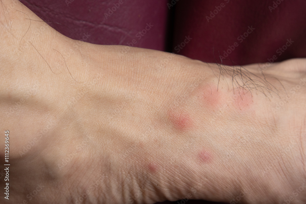 Fototapeta premium The blisters are red and itchy on the patient's skin that are caused by bites from pet fleas