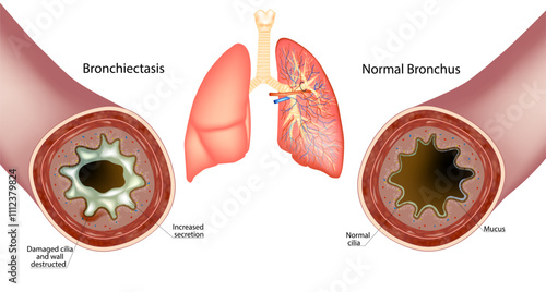 Bronchiectasis and Normal Bronchus. Increased secretion Mucus. Wall destructed and Damaged cilia  Bronchus