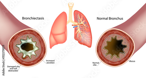 Bild auf Leinwand Bronchiectasis and Normal Bronchus