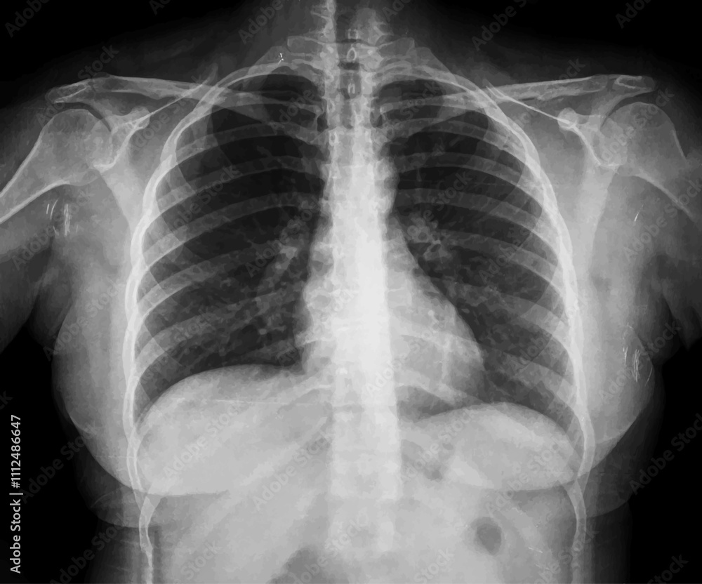 Upright Chest X-Ray for Medical Research and Teaching, vector illustration Upright Chest X-Ray for Medical Research and Teaching, vector illustration
