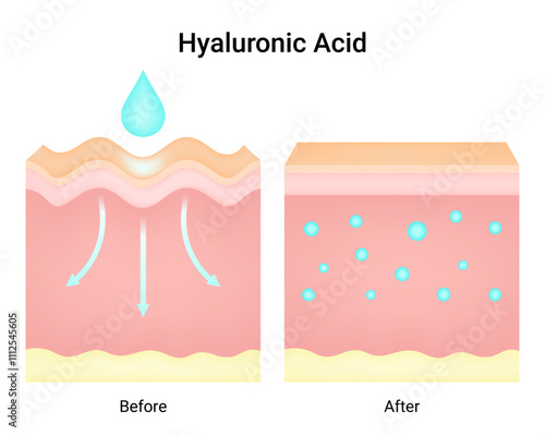 Differences in Use of Hyaluronic Acid Before and After