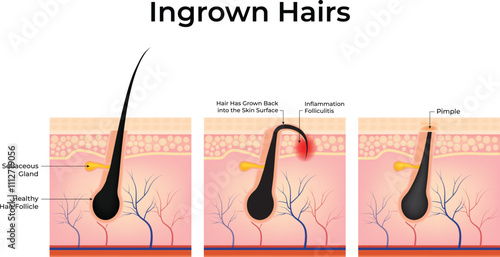 Ingrowen Hairs Design Vector Illustration