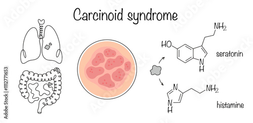 Carcinoid syndrome