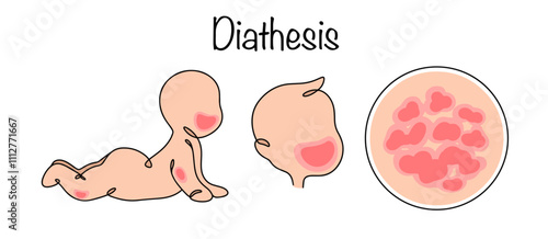 Diathesis