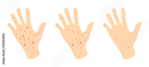 Visual representation of skin conditions showing hands with varying levels of irritation and redness.