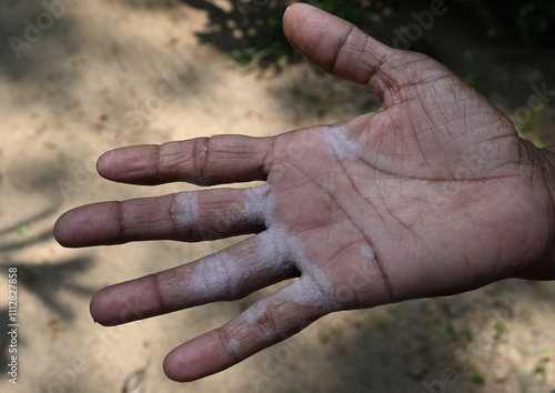 View of a mature Asian woman's palm with dermatitis or allergies on a hand surface