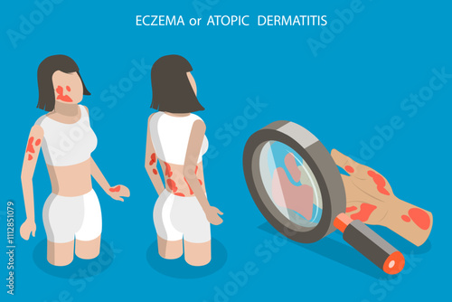 3D Isometric Flat Vector Illustration of Atopic Dermatitis, Person With Eczema Scratches Itchy Skin