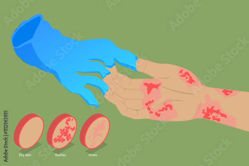 3D Isometric Flat Vector Illustration of Latex Allergy, Skin Reactions From Chemical Exposure