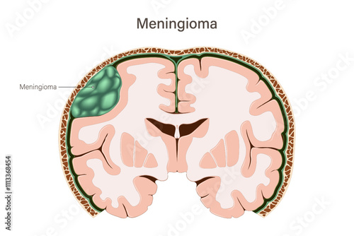 Meningioma. Brain tumors vector. Brain cancer. Human brain structure.