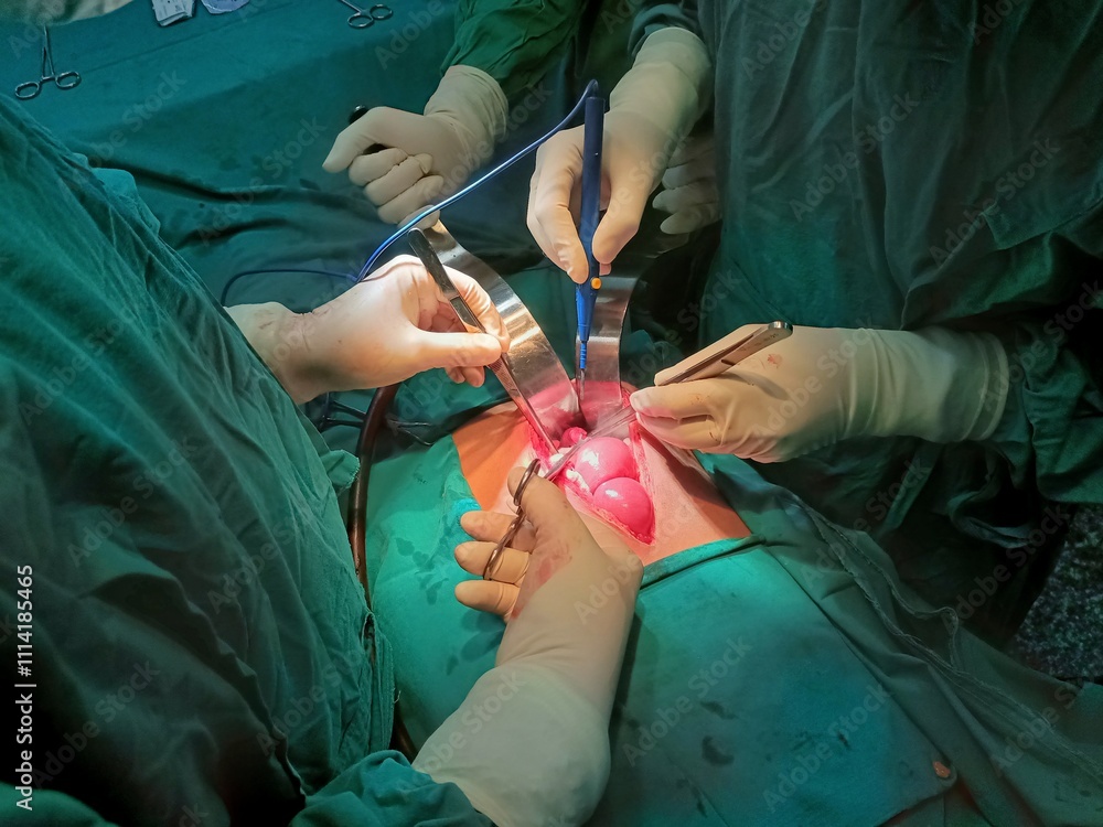 Surgery of abdominal, Resection of Small Bowels with Ligation of vessels during operation. Step by step surgery. Surgery of abdominal, Resection of Small Bowels with Ligation of vessels during operation. Step by step surgery.
